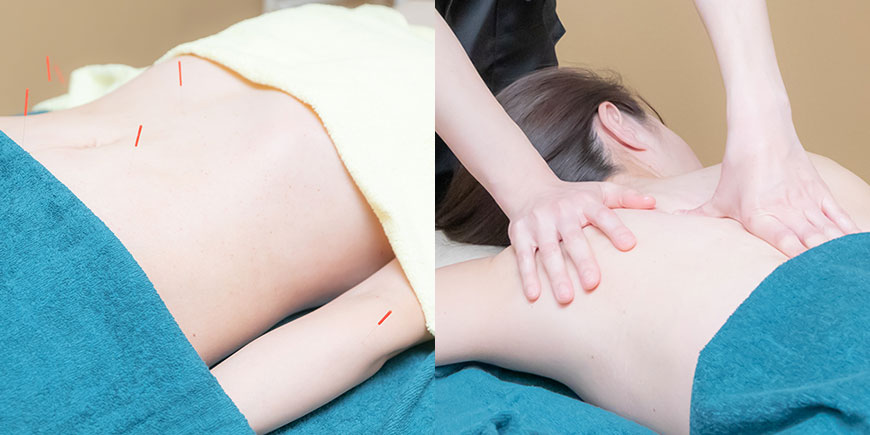 背中や腕の鍼治療やマッサージを受ける女性